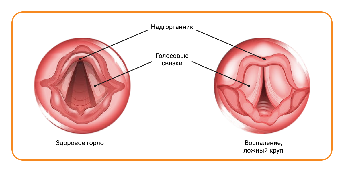 Ларингит у детей